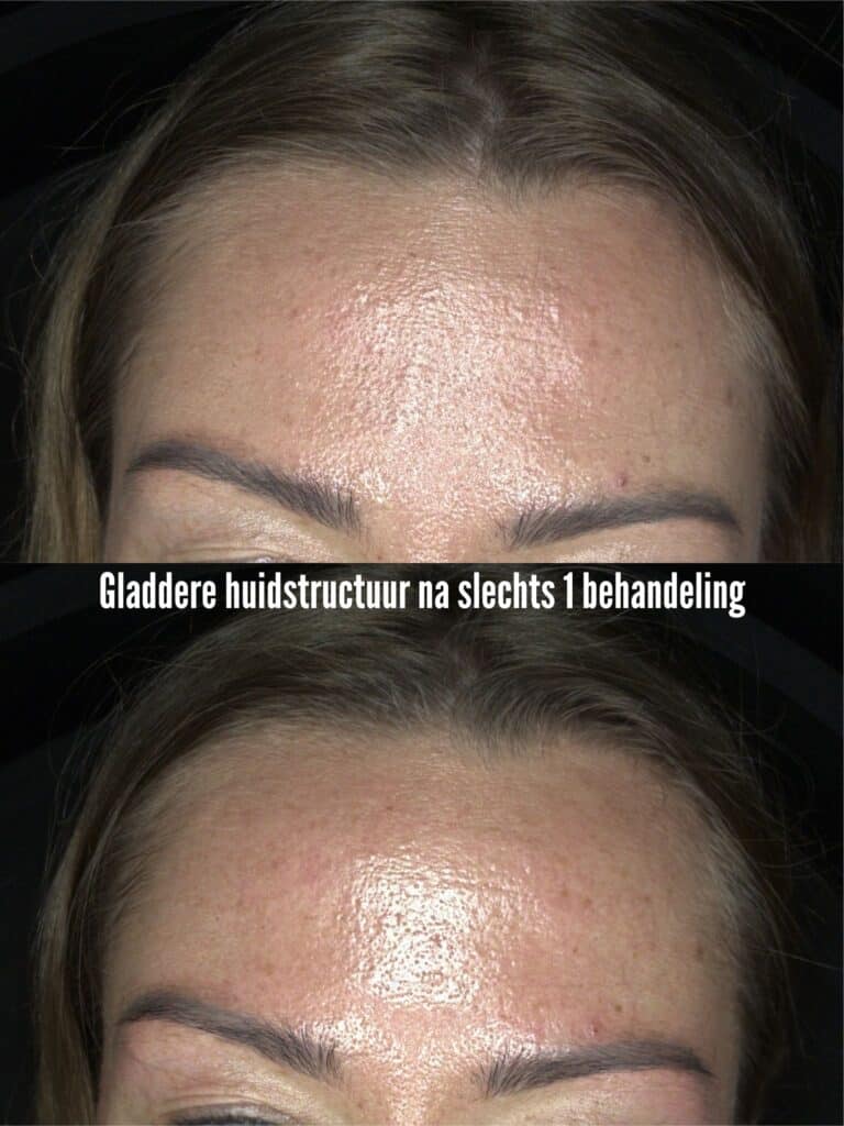 Gladdere huidstructuur na slechts 1 behandeling
