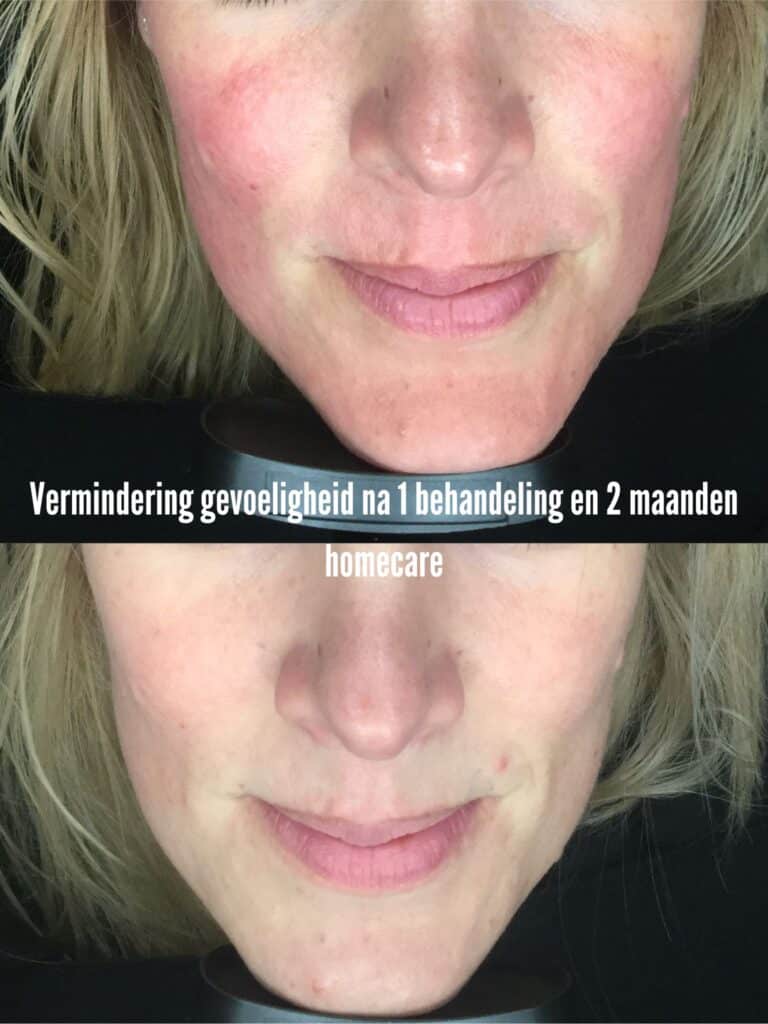 Vermindering gevoeligheid