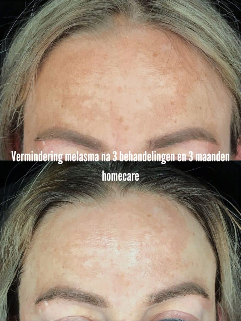 Vermindering melasma
