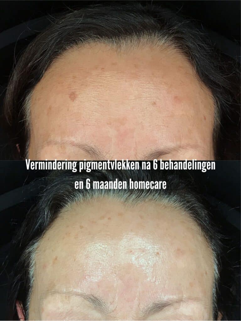 pigmentvlekken verminderen
