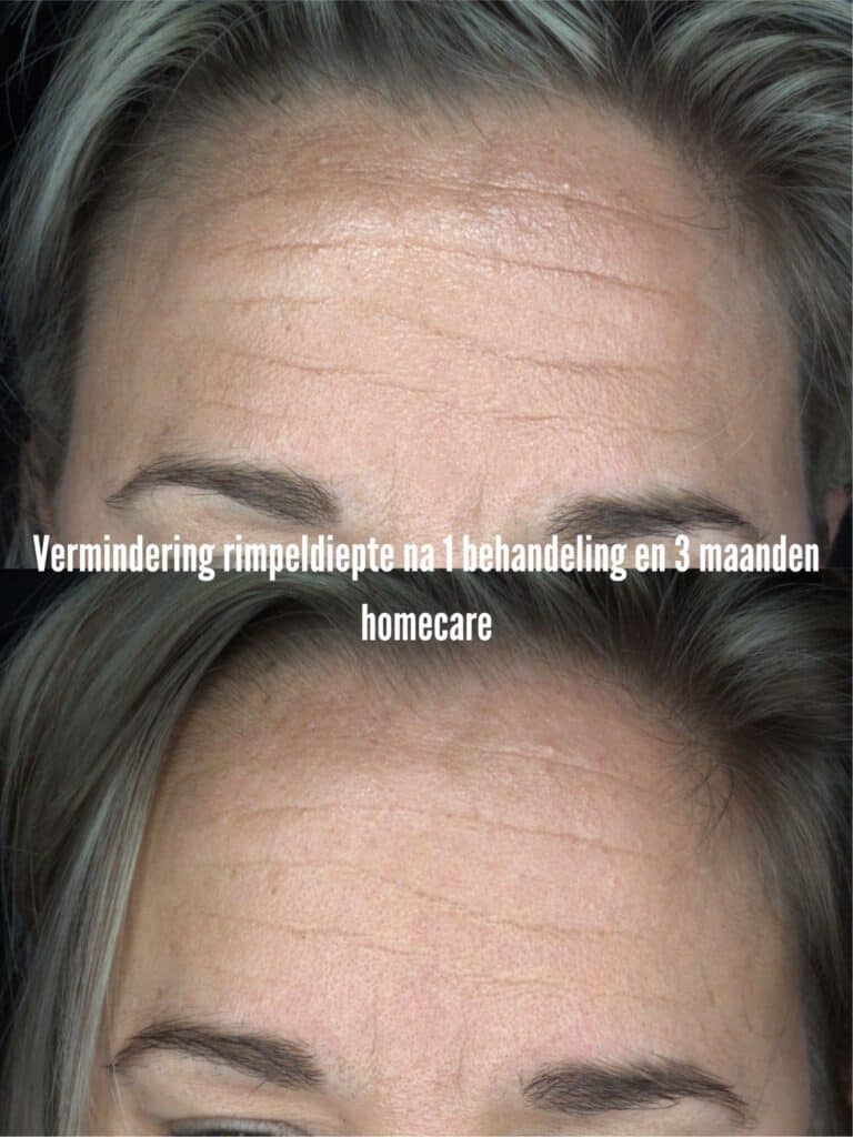 rimpels verminderen