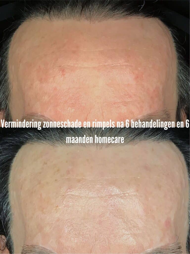 rimpels verminderen